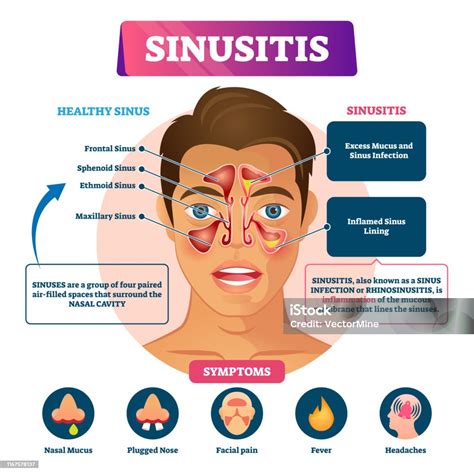 Vetores de Ilustração Do Vetor Da Sinusite Esquema Inflamatório Rotulado De Rinossinusite e mais ...