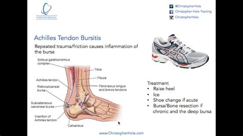 Injuries and Rehab: Achilles Tendon Bursitis - YouTube