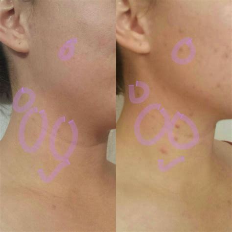 Cystic or hormonal acne demolished using skincerity! www.buynucerity.com/362337 | Hormonal acne ...