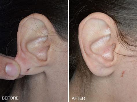 Earlobe Repair Surgery | Miami, FL | Dr. Bared