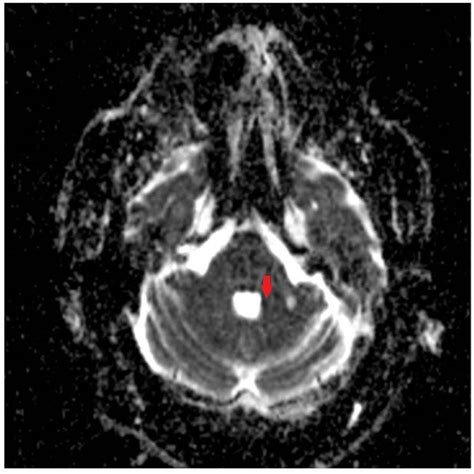 Frontiers | Acute Stroke in Middle Cerebellar Peduncle in a Patient ...