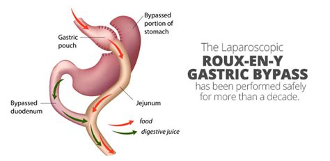 Laparoscopic Roux-en-Y Gastric Bypass | Aloha Surgery | Weight Loss Surgery