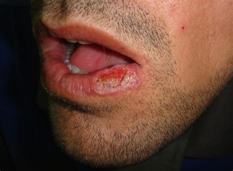 Oral Lichen Planus - Causes, Symptoms, Prognosis, Diagnosis, Treatment