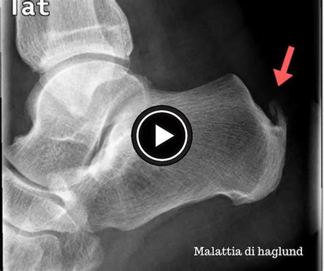 Haglund’s Syndrome and how to solve the problem