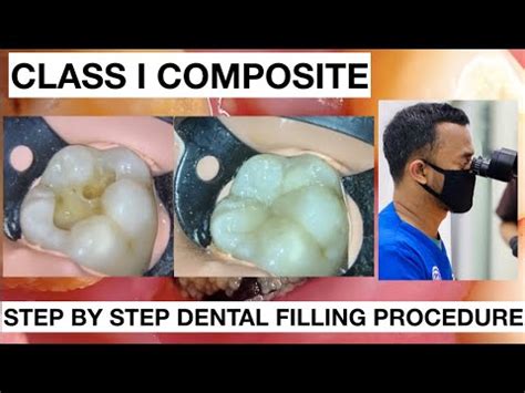 Step by Step Dental Filling Procedure | General Dentist Griya RR - YouTube