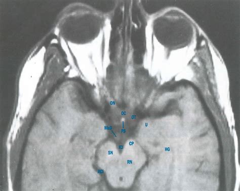 TI-weighted, Optic Chiasm - American Academy of Ophthalmology