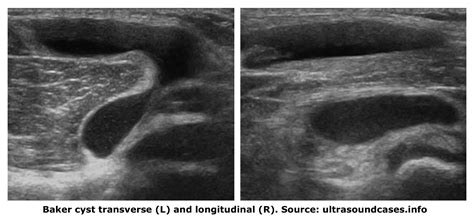 Popliteal Cyst