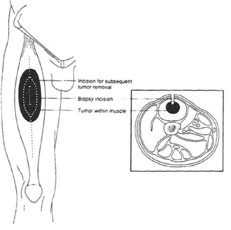 3. Placement of an incisional biopsy incision in a patient with an... | Download Scientific Diagram