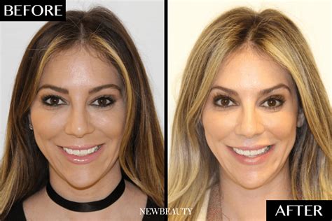 Invisalign Before and After - NewBeauty