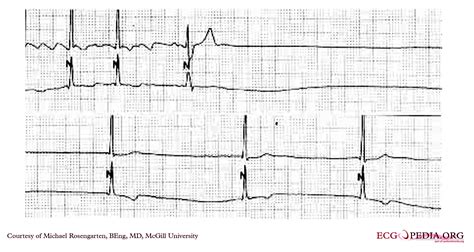 Sick Sinus Syndrome Ekg Examples Wikidoc | Images and Photos finder