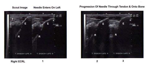 Percutaneous Tenotomy Greenville SC | Needle, Flexor Tenotomy Spartanburg & Anderson