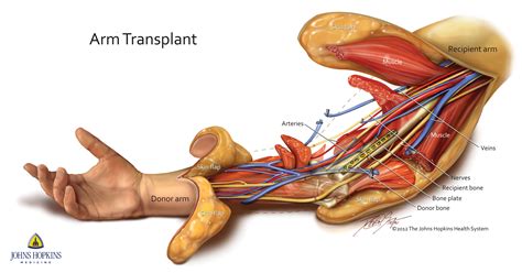 Double-arm transplant helps Soldier who lost limbs in Iraq | Article ...