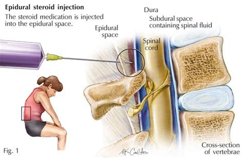 Epidural Steroid Injection