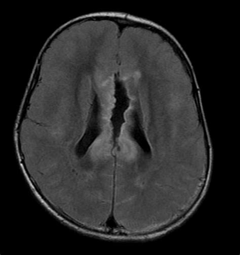 Corpus callosotomy - wikidoc