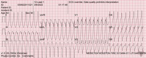 Ventricular Tachycardia | ECG Stampede