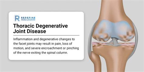 Thoracic Degenerative Joint Disease - NJ's Top Orthopedic Spine & Pain ...