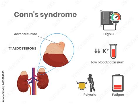 Conn's syndrome causes and symptoms vector illustration. Primary Aldosteronism scientific ...