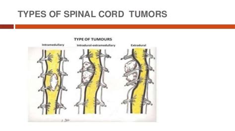 Spinal cord tumors