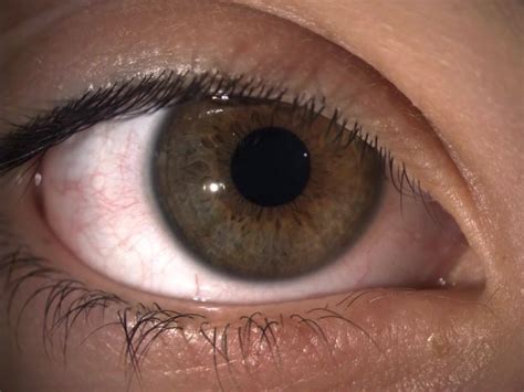 Hippus phenomenon คือ dilating and contracting pupillary movements สามารถพบได้ใน ภาวะปกติก็ได้ ...