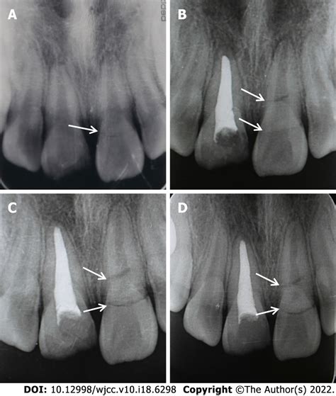 Spontaneous healing of complicated crown-root fractures in children: Two case reports