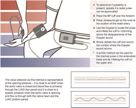 Left Ventricular Assist Devices: A Primer For the General Cardiologist | Journal of the American ...