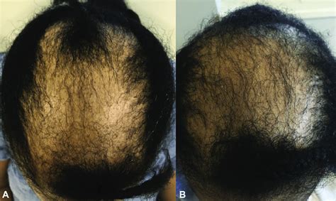 Improvement of central centrifugal cicatricial alopecia after... | Download Scientific Diagram