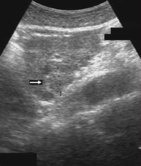 Abdominal sonography shows an isoechoic mass with an incomplete ...