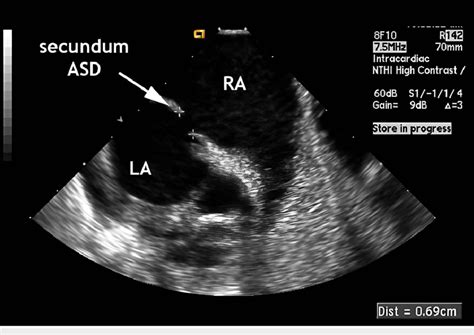 Transesophageal echocardiogram (case 1) showing interatrial ...