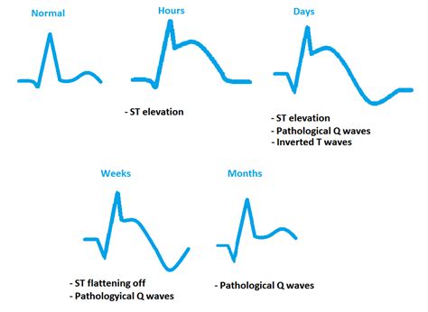 Myocardial Infarction and Acute Coronary Syndromes (ACS) - almostadoctor