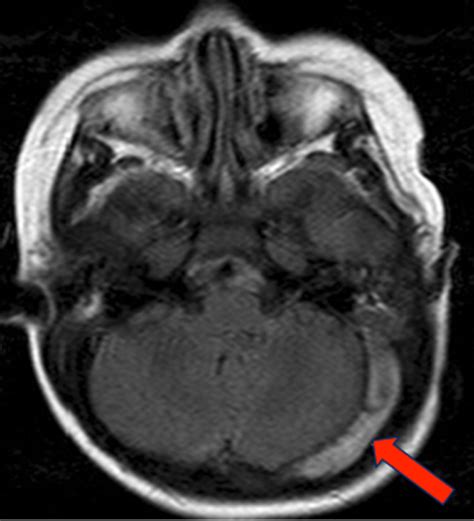 Slow flow v thrombus - Questions and Answers in MRI