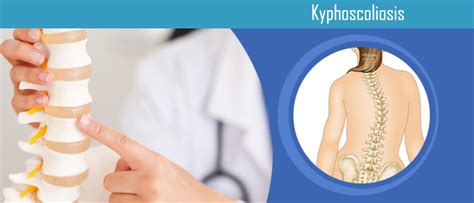 Kyphoscoliosis – Causes, Symptoms and Treatment