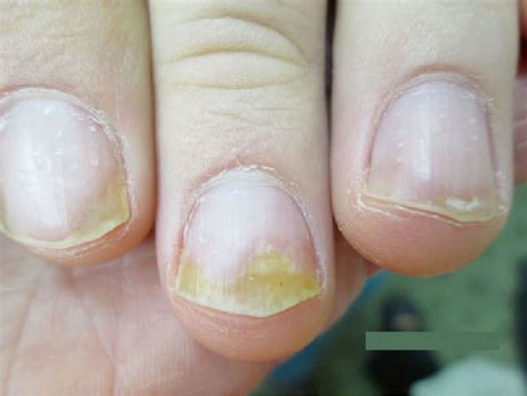 Nail psoriasis causes, symptoms, diagnosis, treatment & prognosis