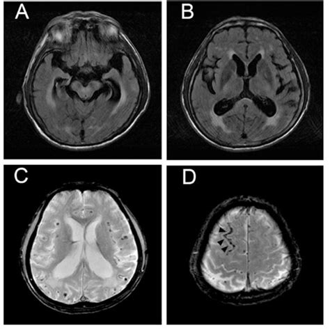 Axial brain MRI showing atrophy of the medial temporal lobes (A ...