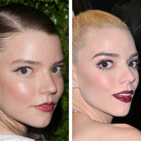 Anya Taylor-Joy Before and After Plastic Surgery