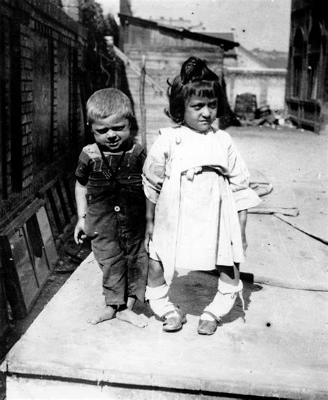 This 1895 photo shows two children suffering from rickets, which is marked by the softening and ...