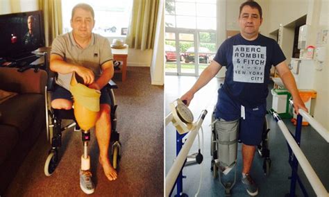 Racing fan had to have his leg amputated after contracting sepsis | Daily Mail Online