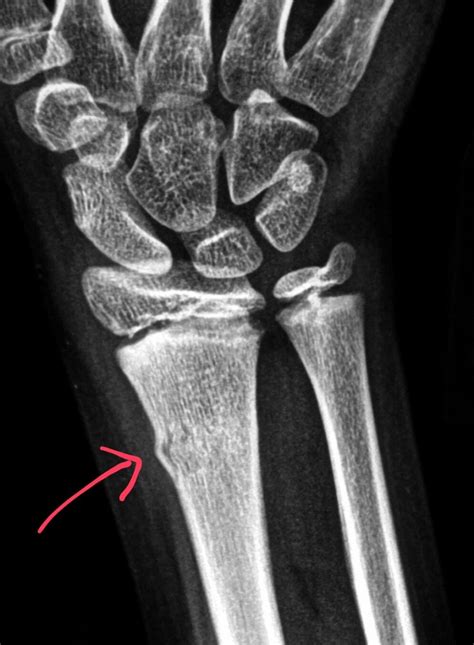 Pin on X-rays