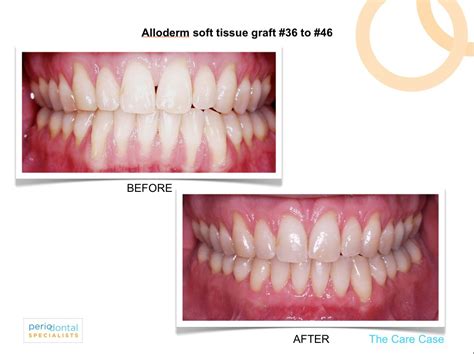 Before and After Gum Graft treatment for receding gums using donor skin graft called ALLODERM ...