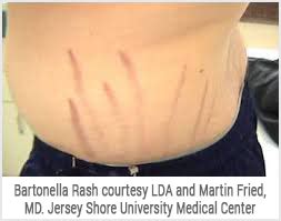 Bartonella: A Lyme Disease Co-infection - LymeDisease.org