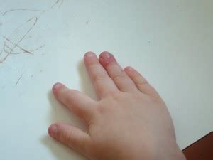 Herpetic Whitlow - Pictures, Symptoms, Causes and Treatment