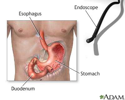 EGD - esophagogastroduodenoscopy Information | Mount Sinai - New York