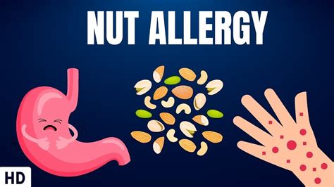 Nut Allergy: Everything You Need To Know - YouTube