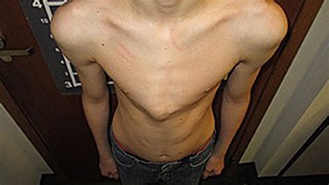 Teen born with a pigeon chest finally stands inch taller | ITV News London