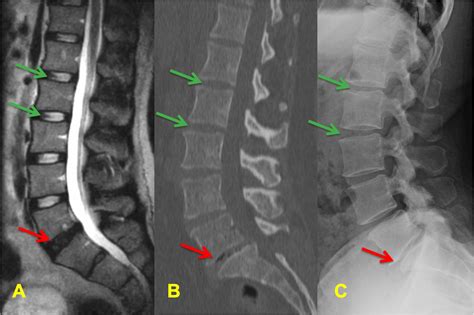 What Is Degenerative Disc Disease Ddd And How Is It T - vrogue.co