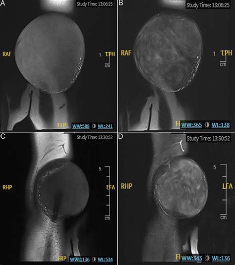 Surgical treatment of tuberous and tendinous xanthoma | CCID