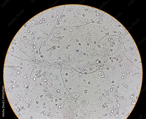 Abnormal result of urinalysis examination from microscopic method under 40X light microscope ...