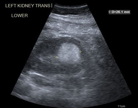 Renal Angiomyolipoma Ultrasound