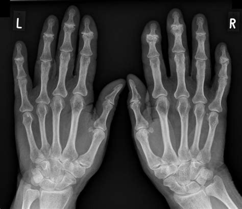 DIP osteoarthritis (Heberden nodes) | Radiology Case | Radiopaedia.org