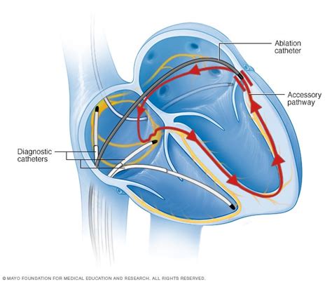 Supraventricular tachycardia - Diagnosis and treatment - Mayo Clinic