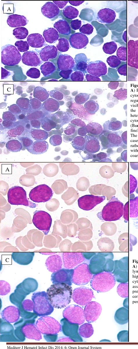 Figure 2 from Diagnosis and Subclassification of Acute Lymphoblastic ...